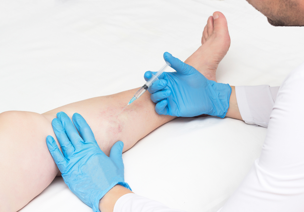 Tratamento de varizes escleroterapia